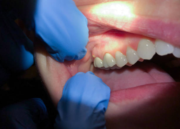 Teeth Whitening in OH